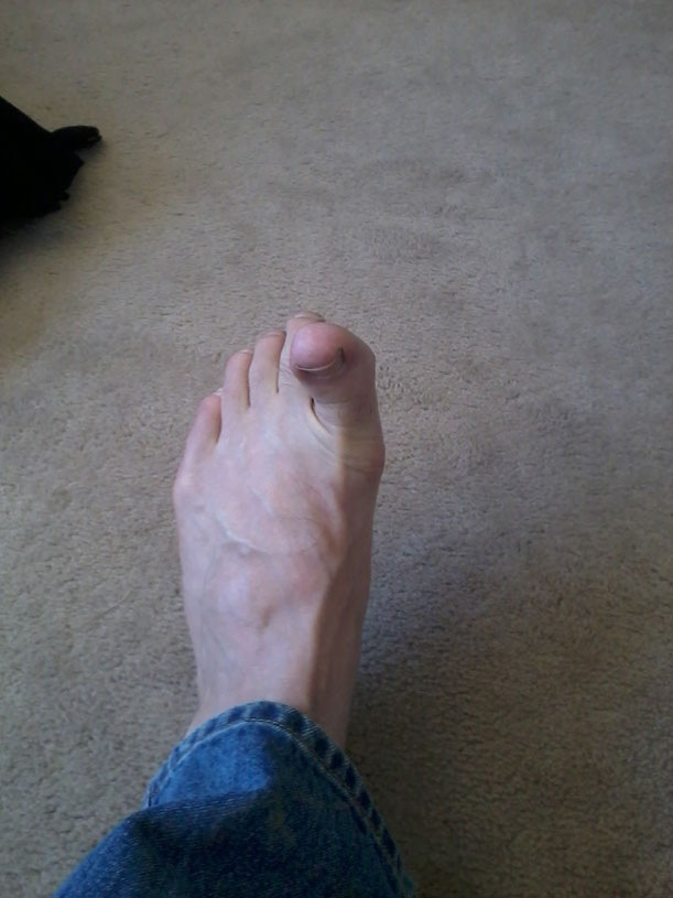 Athletes foot!